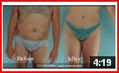 Houston Liposuction Texas
